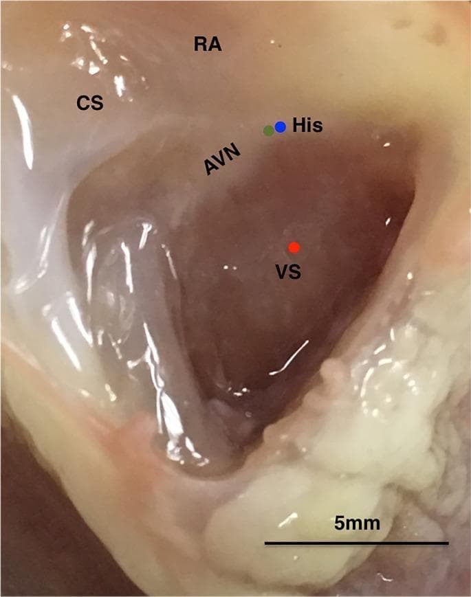 An anatomical clinical photograph of an experimental rabbit heart preparation, used for cardiac electrophysiology research. The image displays the right atrial endocardium and basal ventricular septum after the removal of the right atrium (RA) to expose the cardiac conduction system. Key anatomical landmarks are labeled: the coronary sinus (CS), the atrioventricular node (AVN), the His bundle (His), and the ventricular septum (VS). Specific experimental recording sites are marked with colored dots: a green dot indicates the position of a bipolar electrode on the His bundle; a blue dot represents the site of a glass microelectrode impalement into the His bundle; and a red dot marks the microelectrode recording site on the endocardium of the ventricular septum. A 5 mm scale bar is provided at the bottom right for spatial reference. The photograph demonstrates the anatomical relationships necessary for simultaneous intracellular action potential recording from the specialized conduction system and working myocardium.
