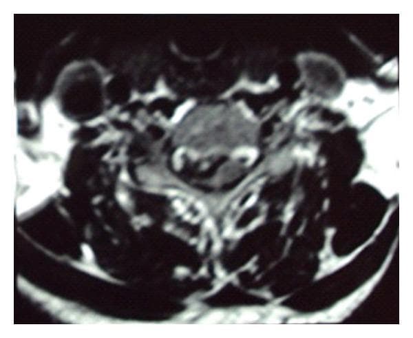 This diagnostic image is an axial T2-weighted MRI of the cervical spine at the C4-C5 level. The scan demonstrates a significant right paracentral disc herniation protruding into the spinal canal. The herniated disc material causes focal mass effect on the right side of the spinal cord, resulting in evident hemicord compression and distortion of the cord's normal elliptical contour. Despite the mechanical compression, the signal intensity within the spinal cord remains relatively uniform, with no definitive T2 hyperintensity to suggest acute myelomalacia or cord edema at this level. The vertebral body and posterior elements are visualized, though anatomical detail is slightly limited by image graininess. This clinical finding correlates with Brown-Séquard Syndrome, characterized by ipsilateral motor deficits and contralateral sensory loss due to unilateral cord compression. This image serves as a key educational example of how a focal disc protrusion can cause significant mechanical deformation of the spinal cord and lead to specific neurological deficits.