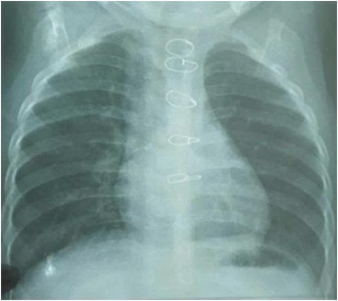 Anterior-posterior (AP) pediatric chest radiograph demonstrating post-surgical changes in an infant. The image reveals multiple radiopaque cerclage wires (sternal wires) along the midline, indicative of a previous sternotomy for cardiac repair, such as for Tetralogy of Fallot. The lung fields appear relatively clear without overt focal consolidation, pleural effusion, or pneumothorax visible at this resolution. The cardiac silhouette is visible, though its assessment is limited by the AP projection and pediatric anatomy. The trachea is midline. Notably, while the image was taken in the context of suspected foreign body aspiration (sunflower seed in the right main bronchus), the object itself is not radiopaque and is not clearly visualized on this X-ray, highlighting the clinical educational point that organic foreign bodies are often radiolucent and may not be detected through standard radiography without secondary signs like localized hyperinflation or atelectasis.