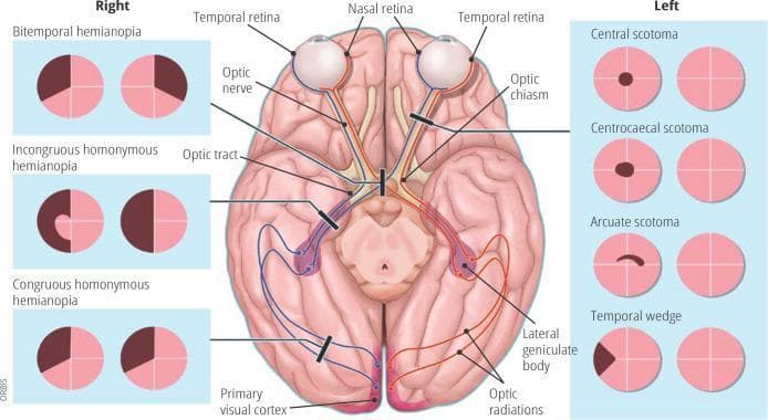 Anatomical diagram and educational infographic detailing the human visual pathway and associated visual field defects. The central illustration shows a superior (dorsal) view of the brain, highlighting the optic nerve, optic chiasm (decussation point), optic tract, lateral geniculate body, optic radiations, and the primary visual cortex in the occipital lobes. Pathways are color-coded (red and blue) to demonstrate the transition from nasal and temporal retinal fibers to the contralateral and ipsilateral hemispheres. Black lesion bars indicate specific sites of damage along this pathway. Flanking the central diagram are clinical representations of visual field loss patterns. The 'Right' panel displays bilateral defects including bitemporal hemianopia, incongruous homonymous hemianopia, and congruous homonymous hemianopia. The 'Left' panel displays unilateral or localized defects including central scotoma, centrocaecal scotoma, arcuate scotoma, and temporal wedge. This diagram serves as a neuro-ophthalmological guide for localizing lesions within the central nervous system based on perimetry findings.