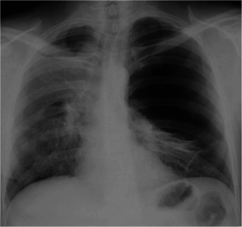 This diagnostic image is an anteroposterior (AP) chest plain film (X-ray) demonstrating advanced bullous emphysema, specifically illustrating features consistent with Vanishing Lung Syndrome. The primary finding is a giant, thin-walled bulla in the right hemithorax, which is significantly hyperextended and occupies approximately two-thirds of the hemithorax volume. This large, space-occupying lesion causes a visible mass effect, resulting in a shift of the mediastinum toward the right and substantial compression of the adjacent right lung parenchyma, which appears poorly expanded. The left lung also demonstrates hyperlucency and signs of bullous disease. Key clinical concepts illustrated include the radiographic presentation of pulmonary bullae, the compressive effects of giant bullae on mediastinal structures, and postoperative complications like secondary pneumothorax. This image serves as an educational example for pulmonology and thoracic surgery, particularly regarding the diagnosis and surgical management of end-stage bullous lung disease and COPD.