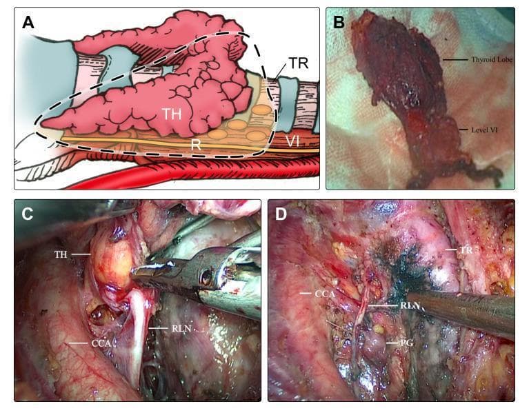 This composite figure illustrates a modified en-bloc resection technique for thyroid lobectomy and central neck dissection (CND). Panel A is an anatomical diagram showing the surgical area, including the thyroid (TH), trachea (TR), common carotid artery (CCA), and Level VI central compartment lymph nodes. Panel B displays a clinical photograph of a resected gross specimen, showing a thyroid lobe attached to a stalk of Level VI fibro-fatty tissue, demonstrating en-bloc removal. Panels C and D provide intraoperative endoscopic views during thyroidectomy. Panel C shows the surgical manipulation of the thyroid lobe (TH) in proximity to the recurrent laryngeal nerve (RLN) and the CCA. Panel D highlights the preservation of critical structures post-resection, including the RLN, parathyroid gland (PG), and trachea (TR) relative to the common carotid artery (CCA). The figure demonstrates the surgical anatomy and the objective of maintaining structural integrity of vital nerves and glands during oncologic resection of papillary thyroid carcinoma.