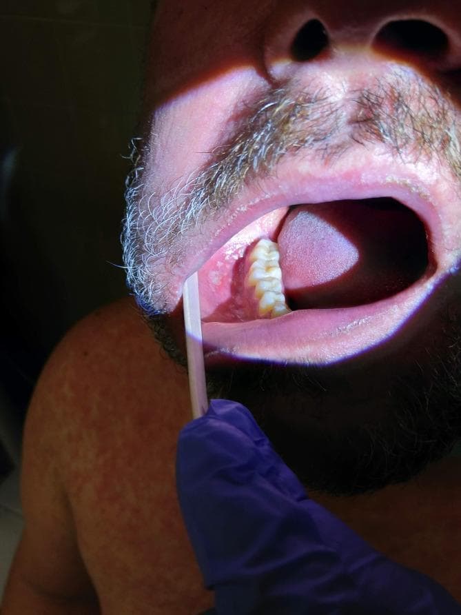 This clinical photograph shows the intraoral cavity and shoulder of an adult male, highlighting pathognomonic signs of a viral exanthem. The primary focus is the buccal mucosa, which is retracted to reveal Koplik's spots: multiple small, 1–2 mm, irregular, bluish-white or gray-white grain-like elevations on an erythematous base. These spots are located opposite the mandibular molars. In the background, the patient's shoulder and chest display a faint, widespread, red maculopapular rash. The image demonstrates key diagnostic features of the prodromal phase of measles (rubeola), where intraoral lesions precede the full systemic rash. This visual is suitable for medical education regarding infectious diseases, dermatology, and clinical diagnosis of childhood and adult exanthems.