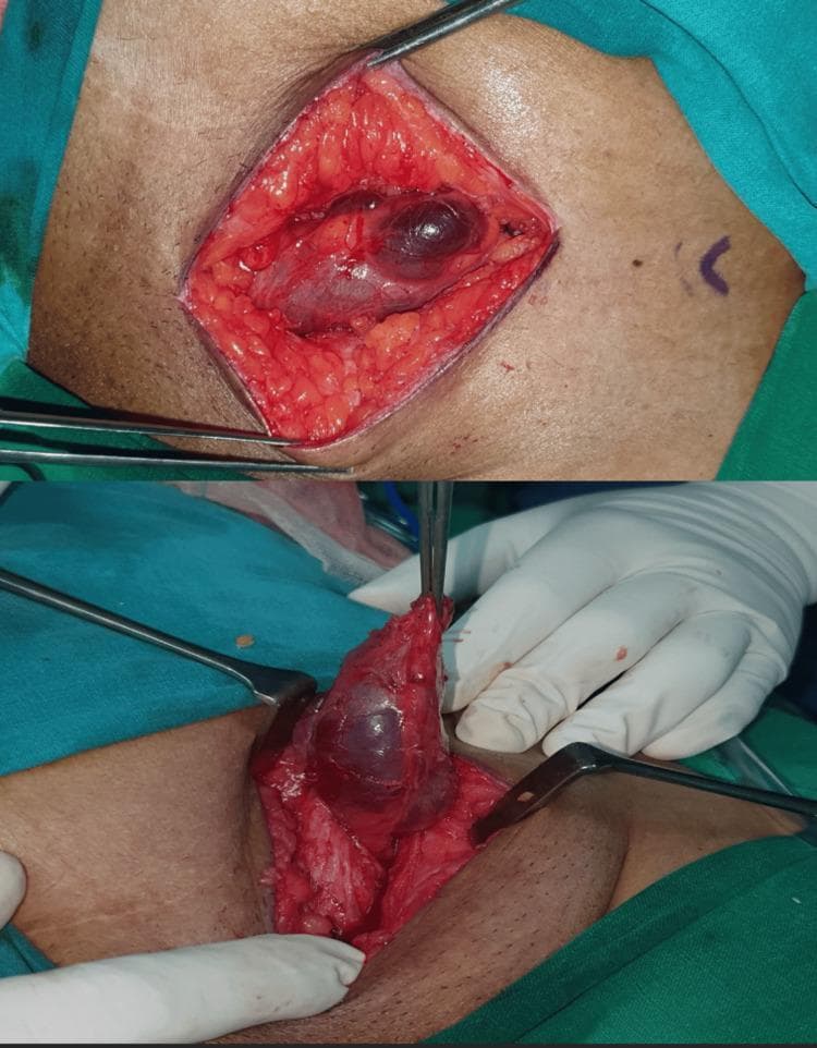 Two intraoperative clinical photographs demonstrate a surgical exploration of the inguinal region for a hydrocele of the canal of Nuck. The top panel shows an open surgical field with skin and subcutaneous fat retracted, revealing an elongated, bluish, fluid-filled cystic sac lying within the inguinal canal. The bottom panel shows the surgical dissection and mobilization of the same sac, which is being held by forceps and pulled upward to demonstrate its attachment to the round ligament. The lesion is smooth-walled, tense, and translucent, characteristic of a hydrocele. The surrounding anatomy includes the dissected inguinal canal and layers of the abdominal wall. These images illustrate the surgical presentation and operative approach for managing Nuck's cyst in a female patient, emphasizing the need to trace the sac to the deep inguinal ring to ensure complete excision.