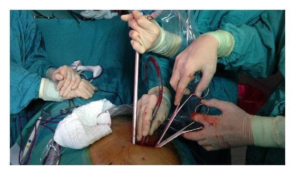 This clinical photograph captures an intraoperative view of a minimally invasive thoracic procedure, specifically a uniportal video-assisted thoracoscopic surgery (VATS). The image shows multiple long, slender surgical instruments, including a thoracoscope, grasping forceps, and a curved suction-irrigation device, simultaneously inserted through a single small utility incision in the lateral chest wall, typically at the 5th intercostal space. Gloved surgeons are seen manipulating these instruments to access the hilar structures of the lung. A sterile field is maintained with green surgical drapes and a clear plastic sleeve covering the thoracoscope cable. The educational focus of the image is the technical challenge of instrument triangulation and coordination required when performing major lung resections through a single-port approach, emphasizing the use of specialized long and curved instrumentation to maintain adequate visualization and exposure of the pulmonary parenchyma and hilar anatomy.
