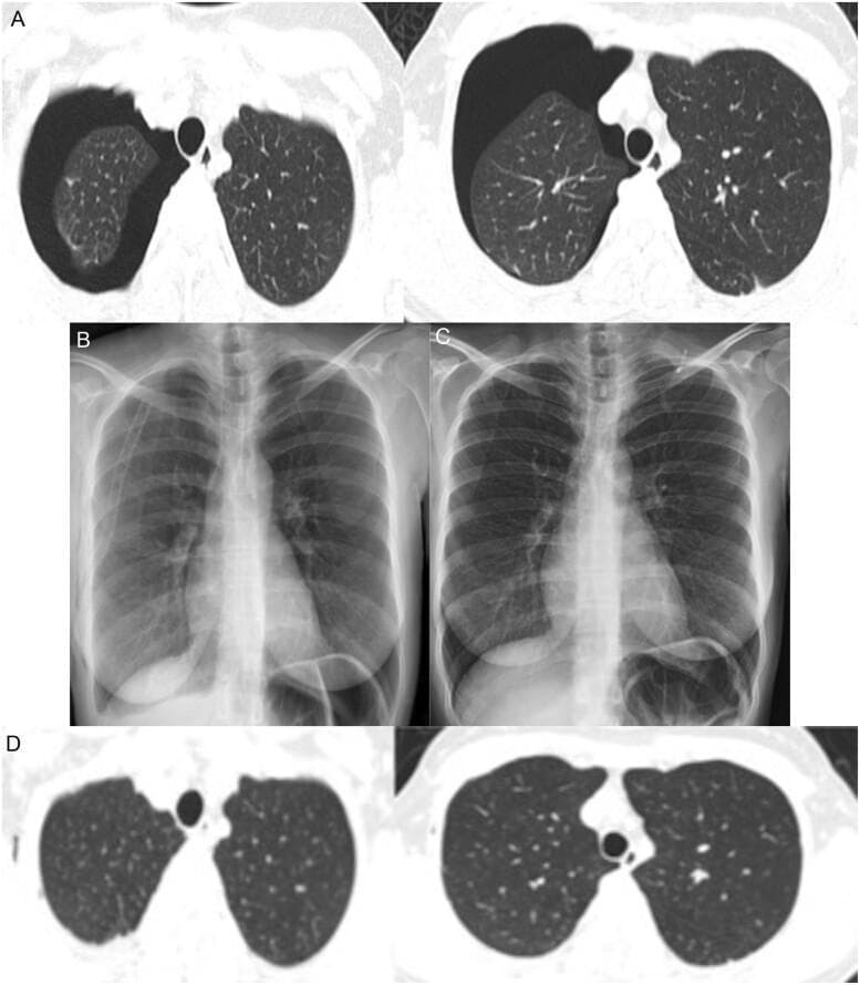 A multi-panel medical image sequence documenting the progression and resolution of a right-sided pneumothorax. Panel A presents axial Thorax Computed Tomography (TCT) lung window slices showing a significant right pneumothorax, characterized by a large, dark, air-filled pleural space (radiolucency) causing collapse of the right lung toward the mediastinum; the left lung remains fully expanded with normal density. Panel B is a Posteroanterior (PA) chest X-ray taken after tube thoracostomy, showing the right lung successfully re-expanded with the chest tube in situ. Panel C displays a follow-up chest X-ray after removal of the chest tube on the fifth day, maintaining full lung expansion and clear costophrenic angles. Panel D shows a follow-up axial TCT image two weeks post-discharge, confirming complete resolution of the pneumothorax with bilateral symmetric lung expansion and normal lung parenchyma. This sequence illustrates the clinical management of a spontaneous pneumothorax in the context of COVID-19 infection, from acute presentation to complete recovery.