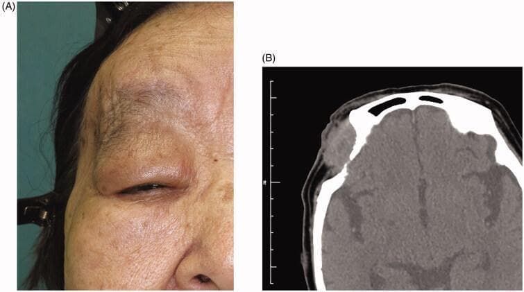 This composite image consists of a clinical photograph and a diagnostic radiological scan illustrating a chronic orbital dermoid cyst. Figure A is a clinical photograph of an elderly patient's right periorbital region. It demonstrates significant mechanical ptosis of the right upper eyelid and a visible mass in the lateral orbital area, causing focal swelling and redundant skin. Figure B is an axial computed tomography (CT) scan of the head at the level of the orbits. The scan reveals a well-circumscribed, hypo-dense mass in the right superolateral orbit. There is clear evidence of chronic pressure-related bone remodeling and erosion, specifically involving the frontal bone and frontosphenoidal suture area, resulting in an indented orbital margin. The clinical and radiological findings are consistent with a long-standing, slow-growing orbital cyst, such as a dermoid cyst, which has caused secondary structural deformation of the surrounding bony architecture.