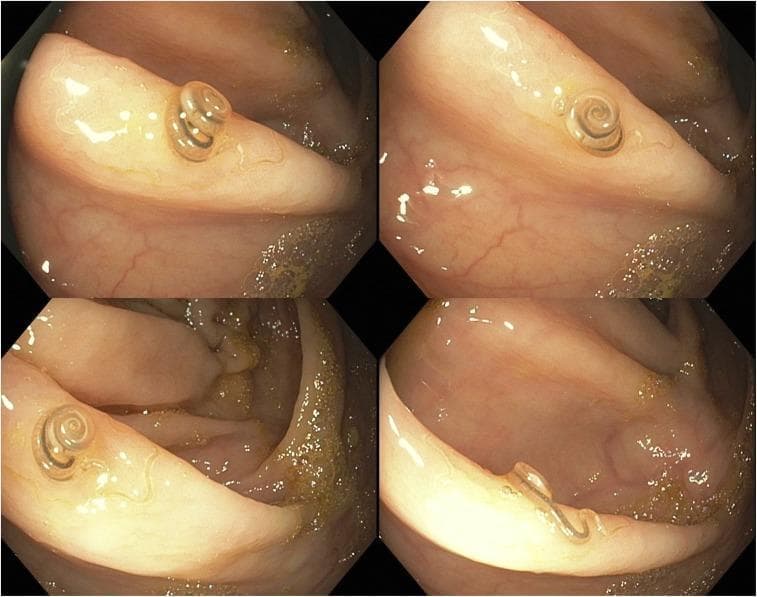This diagnostic image is a four-panel colonoscopy collage showing a live helminth, identified as Trichuris trichiura (whipworm), located on the ileocecal valve. The organism is brown and exhibits a characteristic morphology: a thin, thread-like anterior end partially embedded in the colonic mucosa and a thicker, coiled posterior end resembling a watch spring or spiral. The surrounding intestinal lining appears healthy, characterized by a pinkish-tan hue, visible mucosal folds, and a glistening surface with normal vascular patterns. Minor amounts of yellow fecal debris and clear intestinal fluid are present. The image demonstrates the clinical manifestation of trichuriasis in a symptomatic patient presenting with weight loss and eosinophilia. It serves as an educational example of how parasitic infections can be directly visualized during lower gastrointestinal endoscopy and highlights the specific appearance of whipworms within the human gastrointestinal tract for gastroenterology and infectious disease training.