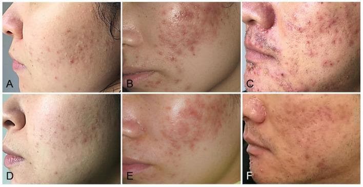 A series of clinical photographs illustrating the treatment of acne vulgaris categorized by severity. The top row (A, B, C) shows 'before' images, and the bottom row (D, E, F) shows 'after' images following a 2-month combined therapy. Panels A and D represent a mild case, showing a reduction in small, scattered inflammatory papules and comedones. Panels B and E depict a moderate case, showing a significant decrease in the density of erythematous papules and pustules on the cheek. Panels C and F represent a severe case, demonstrating an improvement in widespread inflammatory lesions, nodules, and post-inflammatory hyperpigmentation. Overall, the post-treatment images (D-F) show marked improvement in skin texture, a reduction in total lesion count, and a decrease in associated erythema across different grades of acne severity.