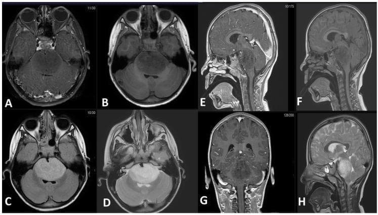 This diagnostic imaging panel consists of eight MRI slices (axial, sagittal, and coronal planes) demonstrating an expansile intra-axial mass in the brainstem, characteristic of a Diffuse Midline Glioma (DMG). The mass is primarily centered in the pons and exhibits a classic radiological profile: hypointense signal on T1-weighted pre-contrast (B, F) and post-contrast (A, E, G) sequences, indicating a lack of significant enhancement. T2-weighted (D, H) and FLAIR (C) sequences show the lesion as uniformly hyperintense. Anatomically, the tumor causes significant expansion of the pons, leading to the obliteration of the prepontine cistern and encasement of the basilar artery. Posteriorly, the mass compresses the fourth ventricle, though no proximal obstructive hydrocephalus is currently evident. Sagittal and coronal views (E, F, G, H) illustrate the longitudinal extent of the lesion, stretching from the pontomesencephalic junction superiorly to the pontomedullary junction inferiorly, with characteristically ill-defined, infiltrative borders. This series serves as a pedagogical example of the typical imaging features and local mass effect of pontine gliomas in neuro-oncology.
