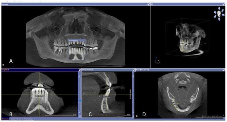 This composite diagnostic image illustrates the application of Cone Beam Computed Tomography (CBCT) and Orthopantomography (OPG) in dental radiology for evaluating periodontal osseous lesions. Panel A displays a panoramic OPG, providing a wide-field view of the maxilla, mandible, and full dentition to identify alveolar crest levels and general bone loss. Panel B presents a tangential CBCT view, optimized for measuring interproximal osseous defects between adjacent teeth. Panel C shows a cross-sectional (buccolingual) slice, used to detect bone loss and cortical plate integrity on the buccal and lingual aspects. Panel D features an axial CBCT view of the mandible, demonstrating the relationship between molar roots and the surrounding alveolar bone, particularly useful for identifying furcation involvement and defects. The top right panel provides a 3D volumetric reconstruction of the skull and dentition. Key educational concepts include the multi-planar assessment of bone height, the detection of vertical and horizontal osseous defects, and the identification of furcation radiolucencies in periodontology.