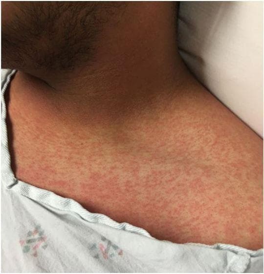 This clinical photograph displays a diffuse, erythematous maculopapular rash on the upper chest, neck, and shoulder of a patient. The dermatologic manifestation consists of numerous small, red macules (flat spots) and papules (slightly raised bumps) that are densely distributed across the skin surface. The pattern is characteristic of the exanthem seen in Zika virus infection, often described as a mild, dengue-like febrile illness. The image captures the anterior thoracic region near the clavicle and the lateral neck, illustrating the typical morphology and widespread distribution of the rash associated with flavivirus infections. This visual is a key educational resource for recognizing the clinical signs of emerging infectious diseases in a dermatology or emergency medicine context.