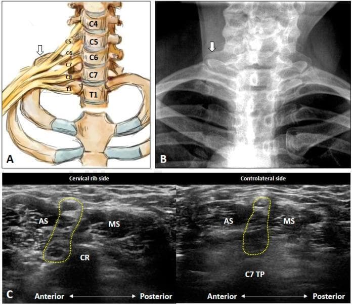 This composite image illustrates the anatomy and diagnosis of a cervical rib through three modalities. Panel A is an anatomical diagram showing the cervical vertebrae (C4-T1), the first and second ribs, and the brachial plexus (C5-T1). A white arrow identifies a cervical rib emerging from the C7 vertebra. Panel B is a posterior-anterior (PA) neck X-ray demonstrating a radiopaque bony projection (cervical rib) at the C7 level, indicated by a white arrow. Panel C provides a comparative ultrasound study in the transverse plane. The left image (Cervical rib side) shows a hyperechoic structure (CR) with posterior acoustic shadowing located between the anterior scalene (AS) and middle scalene (MS) muscles, encroaching upon the brachial plexus (yellow dashed circle). The right image (Contralateral side) shows the normal anatomy of the C7 transverse process (C7 TP) and the interscalene groove containing the brachial plexus. These images demonstrate how a cervical rib can narrow the interscalene space, contributing to neurogenic thoracic outlet syndrome (TOS).