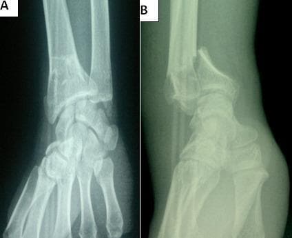 This diagnostic image consists of two preoperative X-ray views of the wrist, illustrating an unstable intra-articular distal radius fracture. View A is an anteroposterior (AP) radiograph showing comminution and a clear sagittal fracture line extending into the radiocarpal joint space. View B is a lateral radiograph demonstrating a Goyrand-Smith fracture, characterized by significant volar (palmar) displacement and angulation of the distal fracture fragment relative to the radial shaft. The alignment between the distal radius, carpal bones, and distal ulna is severely disrupted, with the carpus following the volar displacement of the distal radial fragment. This case highlights key orthopedic findings for surgical planning, specifically the involvement of the articular surface and the direction of fragment displacement, which distinguishes the Smith fracture from the more common dorsal displacement seen in Colles fractures.