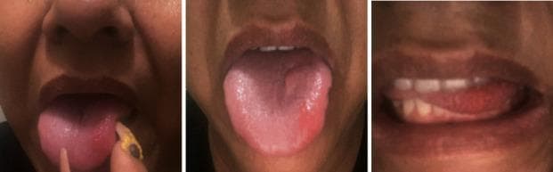 Type: Clinical Photographs. Anatomical Region: Oral cavity, specifically the tongue. Description: A series of three intraoral photographs showing a patient's open mouth with the tongue protruded. The primary finding is a well-circumscribed, painful-appearing aphthous ulcer (stomatitis) located on the left anterolateral aspect of the tongue. The lesion presents as a shallow mucosal defect with a slightly depressed center and an erythematous (reddish) peripheral halo, characteristic of recurrent aphthous stomatitis (RAS). The surrounding lingual mucosa appears moist and otherwise normal. Normal dentition and lips are partially visible. Clinical Significance: These images demonstrate the classic clinical presentation of an aphthous ulcer in a common non-keratinized mucosal site. Such lesions are frequently associated with various systemic conditions, including nutritional deficiencies or gastrointestinal disorders like H. pylori-associated gastritis, and serve as a key diagnostic visual for medical education in oral medicine and dermatology.