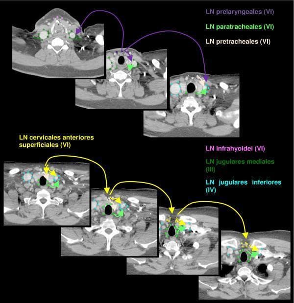 This diagnostic image consists of a series of seven axial computerized tomography (CT) slices of the human neck, illustrating the anatomical delineation of cervical lymph node regions for clinical indexing and radiotherapy planning. The slices are arranged chronologically to show descending anatomical levels. Color-coded contouring identifies specific lymph node (LN) groups: LN cervicales anteriores superficiales (yellow) and LN cervicales anteriores profundi, which are subdivided into LN infrahyoidei (pink), LN prelaryngeales (violet), LN pretracheales (light pink), and LN paratracheales (light green). Additionally, LN jugulares mediales (dark green) and LN jugulares inferiores (cyan) are marked. Key anatomical landmarks visible across the axial plane include the trachea (central air-filled void), the thyroid gland, the carotid arteries and jugular veins (lateral to the trachea), and the cervical vertebral bodies (posterior). The image highlights Level VI (anterior compartment) nodes in relation to Level III and IV (jugular) chains, providing a spatial guide for localizing lymphadenopathy or defining clinical target volumes in head and neck oncology.