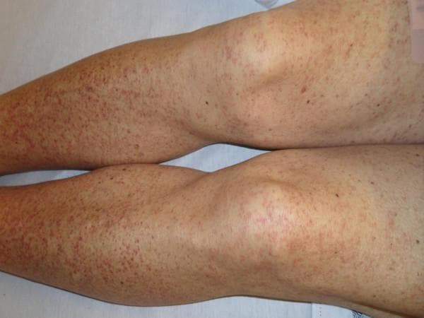 This clinical photograph displays the lower extremities of a patient exhibiting a generalized skin rash. The primary visual finding consists of numerous small, erythematous to purplish macules and papules consistent with palpable purpura. The lesions are bilaterally symmetrical and extensively distributed across the thighs, knees, and lower legs. The morphology shows individual pinpoint lesions (petechiae) and larger coalescing clusters (ecchymoses), particularly concentrated on the shins and calves. This presentation is a classic dermatological manifestation of small-vessel vasculitis, such as IgA vasculitis (Henoch-Schönlein purpura). The image serves as an educational reference for identifying non-blanching, gravity-dependent purpuric eruptions in the context of systemic inflammatory or autoimmune conditions. Clinical significance lies in the recognition of these lesions as a primary diagnostic sign of cutaneous leukocytoclastic vasculitis, often associated with systemic involvement including gastrointestinal symptoms and renal pathology.