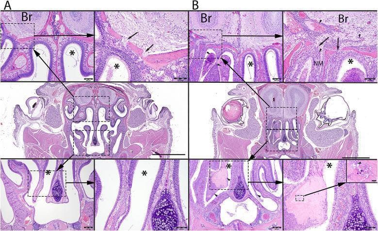 This composite image presents light microscopy findings of Hematoxylin and Eosin (HE)-stained coronal sections of a mouse nasal cavity and olfactory bulb (Br). Panel A shows a control group with a clear, open nasal meatus (*) and a well-defined cribriform plate (arrows) separating the nasal cavity from the brain neuropil. Panel B illustrates the histopathology following Bordetella pertussis challenge, characterized by severe rhinitis. Key diagnostic features in Panel B include the accumulation of dense mucopurulent exudate (arrowheads) within the nasal meatus, composed of neutrophils, proteinaceous debris, and bacteria. High-magnification views of the cribriform plate in the infected model reveal extensive inflammatory cellular infiltrates extending along perivascular spaces and through the cribriform plate into the olfactory bulb (Br), obscuring the nasal mucosa (NM). The images demonstrate the pathological progression from a clear airway to one obstructed by inflammatory exudate and the potential for infection to spread across the anatomical barrier of the cribriform plate into the central nervous system.