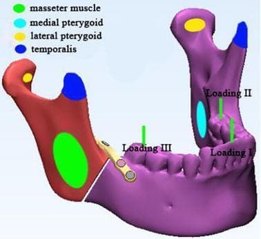This anatomical diagram and biomechanical model illustrates the forces acting on a human mandible with a right-sided angle fracture fixed with a mini-plate. The 3D model identifies muscle attachment zones and occlusal loading points for finite element analysis. Muscle force applications are represented by colored ovals: green for the masseter muscle on the lateral ramus, cyan for the medial pterygoid on the medial ramus, yellow for the lateral pterygoid at the condylar process, and blue for the temporalis muscle at the coronoid process. Three occlusal loading situations are marked with vertical green lines: Loading I at the incisor (125 N), Loading II at the left second molar (250 N), and Loading III at the right second molar (250 N). The image demonstrates the clinical relevance of masticatory force distribution on fracture stability and internal fixation hardware, specifically in the context of mandibular angle fracture management.