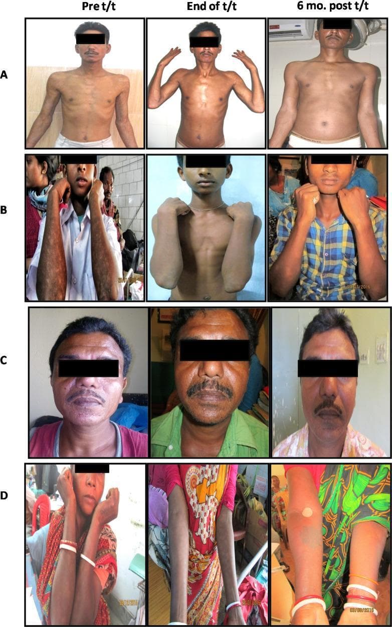 Clinical photograph series illustrating the progression of Post-Kala-Azar Dermal Leishmaniasis (PKDL) in four subjects (A-D) across three temporal stages: baseline (Pre t/t), treatment completion (End of t/t), and six months follow-up (6 mo. post t/t). The visual displays two distinct morphological patterns of PKDL: polymorphic and macular. Subjects A and C demonstrate polymorphic lesions, characterized by various skin manifestations including facial erythema, papules, and nodules. Subjects B and D display macular PKDL, marked by hypopigmented or hyperpigmented macules and patches primarily distributed across the extremities and face. The comparative grid demonstrates the efficacy of Miltefosine (A, B) and Liposomal Amphotericin B (LAmB) (C, D) in reducing lesion density, improving skin tone uniformity, and resolving dermal inflammation. This diagnostic comparison serves to educate on the clinical presentation and therapeutic response of dermal leishmaniasis, a neglected tropical disease. The images focus on the face, torso, and upper limbs to highlight characteristic lesion morphology and their gradual resolution over the follow-up period.