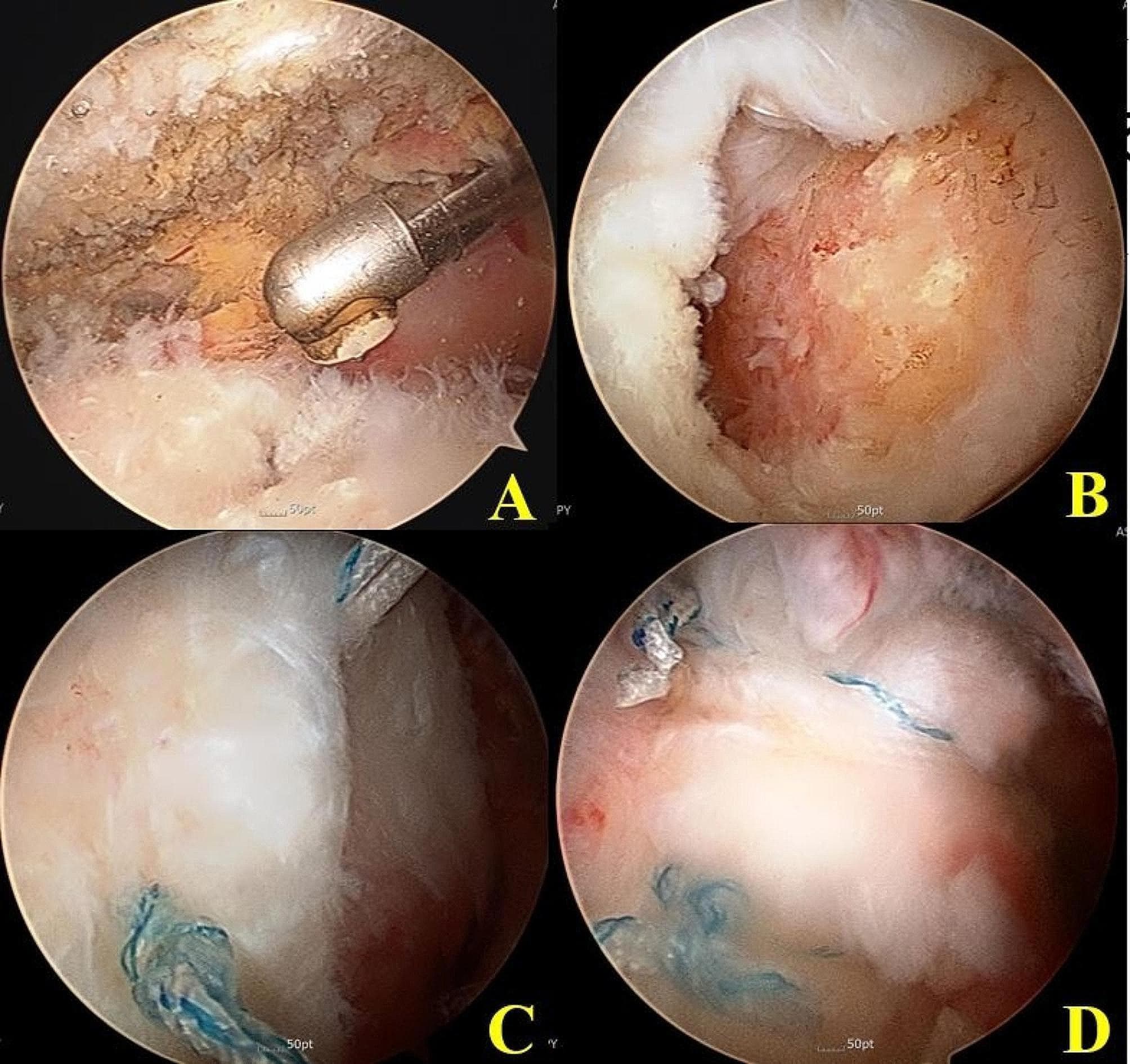 A series of four arthroscopic views (A-D) documenting a remnant-debriding rotator cuff repair procedure. Panel A shows a clinical photograph of the greater tuberosity (GT) footprint with remnant cuff tissue present, characterized by irregular, tan-reddish fibrous tissue, with a surgical debrider in view. Panel B illustrates the same anatomical region after complete debridement, revealing a smooth, uniform surface of exposed bone prepared for anchor insertion. Panels C and D demonstrate stages of a conventional suture bridge rotator cuff repair. Blue braided sutures are visible, showing the transition from medial row fixation with bundled suture material (C) to a completed lateral row bridge configuration (D), where horizontal suture lines are seen compressing the tendon against the GT footprint. These images serve as an educational comparison between initial footprint preparation and final mechanical construct in orthopedic shoulder surgery.