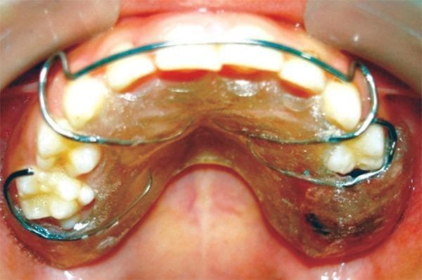 This intraoral clinical photograph displays a maxillary removable acrylic splint appliance positioned in the mouth of a pediatric patient. The appliance features a translucent acrylic base closely adapted to the hard palate and alveolar ridge. A stainless steel wire framework is embedded in the acrylic, consisting of a labial bow that spans the anterior incisors and various retentive components, such as C-clasps or Adams-like clasps, engaging the buccal surfaces of the posterior primary molars and premolars. On the patient's left side (image right), the acrylic base covers an extraction site corresponding to the primary second molar, serving as both a space maintainer and a protective surgical splint for hemostasis. The appliance is designed to provide mechanical stability and protection of the socket in a patient with a bleeding disorder, such as Glanzmann’s thrombasthenia, while awaiting secondary wound healing and permanent tooth eruption.