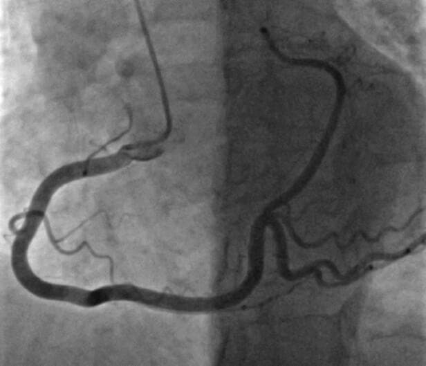 This diagnostic image is a coronary angiogram (fluoroscopic x-ray) demonstrating a right-dominant coronary circulation. The primary focus is the Right Coronary Artery (RCA), which follows a characteristic 'C-shaped' trajectory within the right atrioventricular groove. The vessel exhibits typical anatomy, bifurcating at the crux of the heart into two significant terminal branches: the Posterior Descending Artery (PDA), which travels inferiorly to supply the posterior interventricular septum, and a prominent Posterolateral (PL) branch that travels toward the lateral wall, occupying the territory usually associated with the Left Circumflex Artery (LCX). The image displays the branching pattern and vessel morphology essential for assessing coronary artery disease. A subtle luminal irregularity or darkening is visible along the horizontal segment of the main vessel before the distal bifurcation, which may indicate atherosclerotic plaque or a focal stenosis. This visual serves as an educational example of coronary dominance and normal vs. variant coronary anatomy during cardiac catheterization.