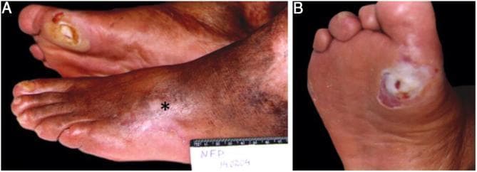 This clinical photograph consists of two panels (A and B) illustrating chronic complications of the diabetic foot. Panel A shows both feet; the left foot presents a healed scar marked with an asterisk (*), indicative of a previous arterial ulcer, while the right foot displays an active neuropathic ulcer located over the plantar aspect of the first metatarsal head. The lower extremities exhibit significant mottled hyperpigmentation and coarse skin texture, suggesting chronic venous or arterial insufficiency. Panel B provides a close-up view of the neuropathic ulcer on the right foot. The lesion is characterized by a central ulceration with a deep, potentially necrotic or fibrin-covered base, surrounded by a prominent, thickened ring of whitish hyperkeratotic callus (perilesional callus). The adjacent tissue shows a reddish-purple hue, consistent with local inflammation or impaired microcirculation. These findings are classic for diabetic neuropathy, where pressure-induced hyperkeratosis precedes ulceration at weight-bearing support points.