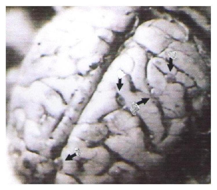 This clinical photograph displays a gross pathological view of a brain (macaque model) illustrating neurocysticercosis. The anatomical focus is on the cerebral cortex, where the characteristic gyri and sulci are visible. Multiple small, discrete, circular to oval-shaped cystic lesions are distributed within the subarachnoid space and along the cortical sulci. These lighter-colored, fluid-filled cysts (indicated by black arrows) represent the larval stage (cysticerci) of the Taenia solium tapeworm. The image demonstrates the typical multifocal distribution of the parasites in a heavy infection scenario, which clinically correlates with symptoms of increased intracranial pressure, seizures, and neurological deficits. This material serves as a translational model for human neurocysticercosis, a major cause of acquired epilepsy globally. The visible pathology highlights the relationship between parasitic localization in the subarachnoid spaces and the resulting parenchymal compression or inflammatory response.
