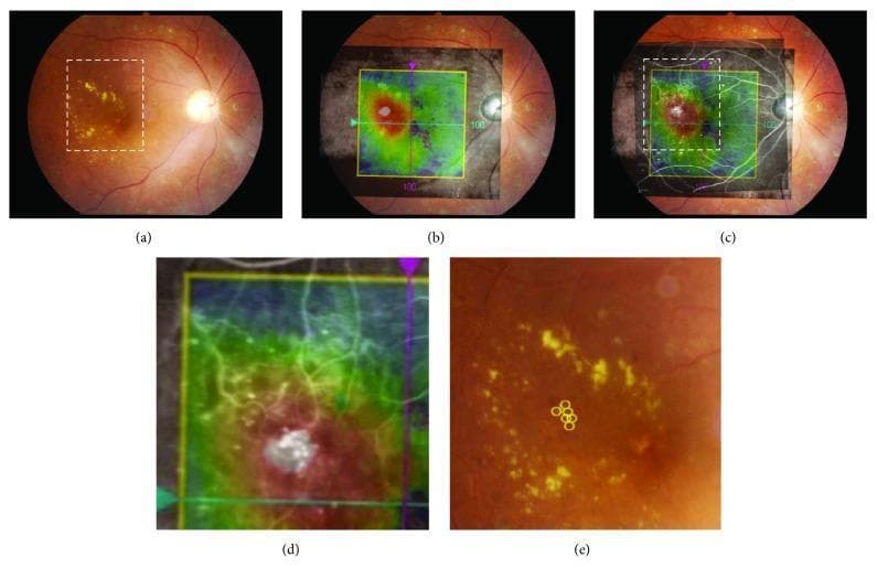 This composite figure illustrates the Merged Image-Guided Photocoagulation (MIG-PC) protocol for treating focal diabetic macular edema (DME). The sequence comprises: (a) A color ocular fundus photograph showing focal DME characterized by a circinate ring of yellowish hard exudates in the macula. (b) An Optical Coherence Tomography (OCT) thickness map overlaid on the fundus photograph, with red/white areas indicating significant retinal thickening. (c) Integration of Fluorescein Angiography (FA) with the OCT map and fundus image to identify leakage points. (d) A high-magnification view of the target area, showing the spatial relationship between the thickened retina and underlying vascular leakage. (e) Final marking of microaneurysms (MAs) with yellow circular annotations to guide laser photocoagulation. The pedagogical focus is the multi-modal integration of diagnostic imaging (OCT, FA, and fundus photography) to enhance the precision of laser treatment for diabetic retinopathy. Key structures include the macula, retinal vasculature, and pathological features like hard exudates and microaneurysms.