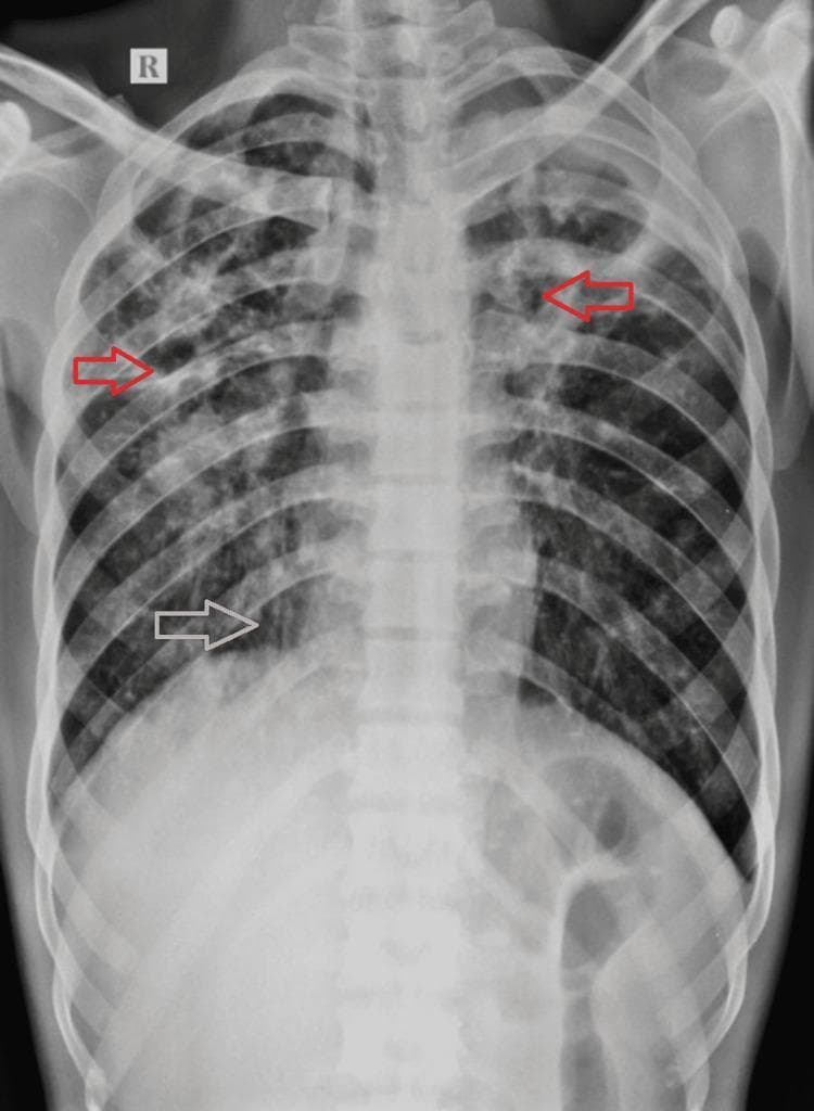 Posteroanterior (PA) chest X-ray demonstrating extensive bilateral pulmonary pathology, highly characteristic of chronic or post-primary pulmonary tuberculosis. The imaging shows widespread, asymmetrical air-space opacities scattered throughout both lung fields, with a greater density and involvement on the right side. Multiple well-defined cavitary lesions are visible, predominantly located in the bilateral upper zones and the right mid-zone (highlighted by red arrows), appearing as radiolucent areas surrounded by thick, irregular walls. In the right lower and upper zones, there is evidence of tractional bronchiectasis (highlighted by white arrows), indicated by tubular lucencies and architectural distortion. The trachea shows a mild shift toward the right, suggesting volume loss or fibrotic changes in the right lung parenchyma. These findings illustrate the chronic sequelae of mycobacterial infection, including lung destruction, cavitation, and secondary airway remodeling.