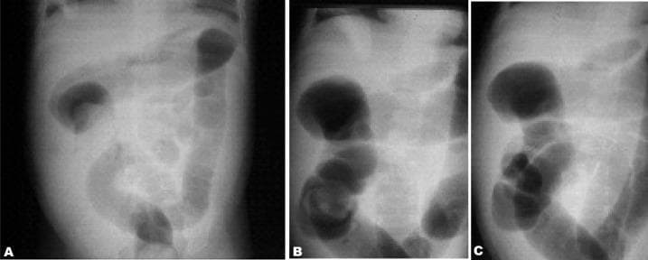 This series of diagnostic X-ray radiographs demonstrates the sequential non-operative reduction of an intussusception using an air enema in a pediatric patient. Panel A shows the intussusceptum as a soft tissue mass (filling defect) within the distal ascending colon, outlined by air. Panel B illustrates the progression of the procedure, with air pressure pushing the intussusceptum proximally toward the cecum, indicated by the shifting position of the mass and the expansion of the air column. Panel C shows the successful completion of the reduction, characterized by the disappearance of the soft tissue mass and the free passage of air into the terminal ileum, representing a resolved ileocolic intussusception. The images provide a clinical example of the 'crescent sign' and 'meniscus sign' often seen during pneumatic reduction, serving as an educational resource for pediatric radiology and emergency gastrointestinal interventions.