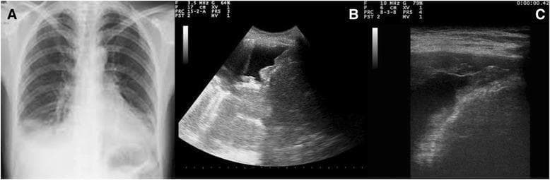 This composite educational graphic compares radiographic and ultrasonographic findings of a pleural effusion. Panel A is a posteroanterior chest X-ray showing a right-sided pleural effusion, characterized by a homogeneous opacity in the lower lung zone with blunting of the costophrenic angle and a visible meniscus sign. Panels B and C are bedside chest ultrasound images (sonograms) of the same patient. These point-of-care ultrasound (POCUS) views provide a more detailed assessment of the pleural space, showing an anechoic (fluid-filled) space consistent with effusion. Notably, the ultrasound images reveal irregular, hyperechoic nodular variations and thickening along the parietal pleura, diaphragm, and costophrenic sinus. These morphological irregularities, which are not visible on the conventional X-ray, are highly suggestive of neoplastic pleural involvement or malignant pleural disease. This comparison illustrates the increased diagnostic sensitivity of ultrasound for evaluating pleural surface morphology in the context of persistent effusion.