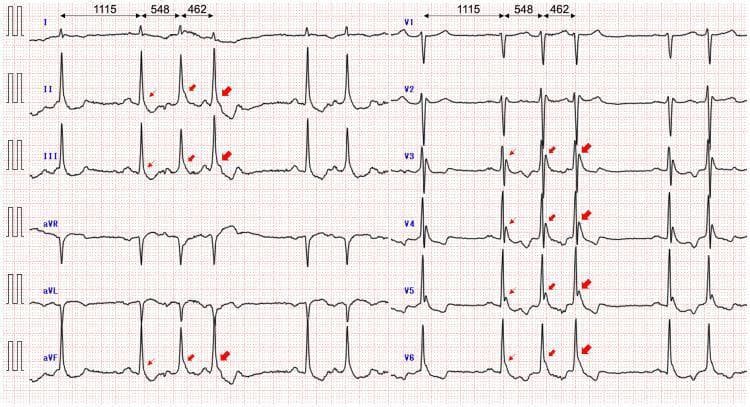 A standard 12-lead electrocardiogram (ECG) demonstrating characteristic findings of hypothermia (recorded at a core body temperature of 28.1°C). The most prominent finding is the presence of Osborn waves (J waves), visualized as a positive deflection or hump at the junction between the QRS complex and the ST segment. These are most marked in the inferior leads (II, III, aVF) and lateral precordial leads (V4-V6), indicated by red arrows. The image shows a dynamic variation in J-wave amplitude, particularly following premature atrial contractions (PACs), where the morphology and height of the deflection change in response to varying RR intervals (labeled as 1115ms, 548ms, and 462ms). Additional features include giant R waves in leads with prominent J waves, a vertical P-wave axis, and a rightward QRS axis shift. The baseline shows minor tremors, common in hypothermic patients. This visual is an educational example of J-point elevation morphology in systemic hypothermia and its relationship with cardiac cycle length.