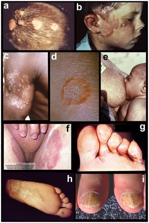 A composite of nine clinical photographs (labeled a-i) illustrating various clinical manifestations of dermatophyte infections (tinea) across different anatomical sites. (a) Tinea capitis on the scalp showing inflammatory patches and alopecia. (b) Tinea faciei presenting as an erythematous, scaly plaque on the cheek and ear. (c) Tinea corporis on the arm displaying an annular morphology with scaly borders. (d) Close-up of tinea corporis (ringworm) emphasizing the characteristic raised, erythematous leading edge and central clearing. (e) Tinea imbricata/corporis on the torso featuring concentric rings. (f) Tinea cruris (jock itch) showing confluent erythematous patches in the inguinal region. (g) Interdigital tinea pedis exhibiting maceration and scaling in the toe webbing. (h) Chronic 'moccasin-type' tinea pedis characterized by diffuse hyperkeratotic scaling on the plantar surface. (i) Onychomycosis presenting as distal subungual thickening, yellowish discoloration, and nail plate dystrophy. The collection serves as an educational reference for dermatological diagnosis based on lesion morphology and distribution.