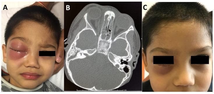 This composite educational graphic illustrates the clinical presentation, diagnosis, and post-operative recovery of a pediatric patient with a sinogenic rhinogenic orbital infection (SROI). Panel A is a clinical photograph showing acute right-sided periorbital cellulitis characterized by significant edema, erythema, and proptosis of the right eye, with the eyelids nearly swollen shut. Panel B is an axial computed tomography (CT) scan in a bone window, demonstrating bilateral ethmoid and sphenoid sinusitis. A white arrow points to opacification of the right ethmoid sinus, while a black arrow highlights a sub-periosteal abscess (SPA) along the medial orbital wall (lamina papyracea), displacing the medial rectus muscle. Panel C shows the patient 10 days post-surgery following endoscopic sinus surgery and external drainage; it demonstrates marked resolution of the inflammatory signs, with significantly reduced swelling and return of normal ocular positioning. This set illustrates Chandler stage 3 orbital complications and highlights the correlation between radiological findings (sub-periosteal abscess) and physical exam signs (proptosis and severe periorbital edema) in the context of acute sinusitis.