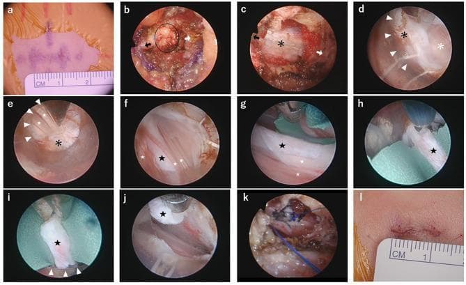 A 12-panel intraoperative visual sequence (a-l) documenting an endoscopic filum terminale resection for a tethered spinal cord. The sequence begins with skin incision marking (a) and progresses through extradural exposure (b, c), showing resection of the interspinous ligament and exposure of epidural fat and the dural sac. The intradural phase begins with a dural incision (d), revealing the arachnoid membrane and the cauda equina nerve roots (e). The filum terminale is identified by its distinctive pale, thickened appearance (f) and is isolated using a green rubber protective underlay (g). The surgical procedure continues with coagulation (h), cutting (i), and resection of the filum segment (j). Final frames demonstrate primary dural suturing using nylon sutures (k) and the closed surgical incision (l). This clinical content illustrates a minimally invasive neurosurgical approach for pediatric spinal dysraphism, highlighting key anatomical landmarks and the step-by-step transition from superficial tissues to the intradural space.