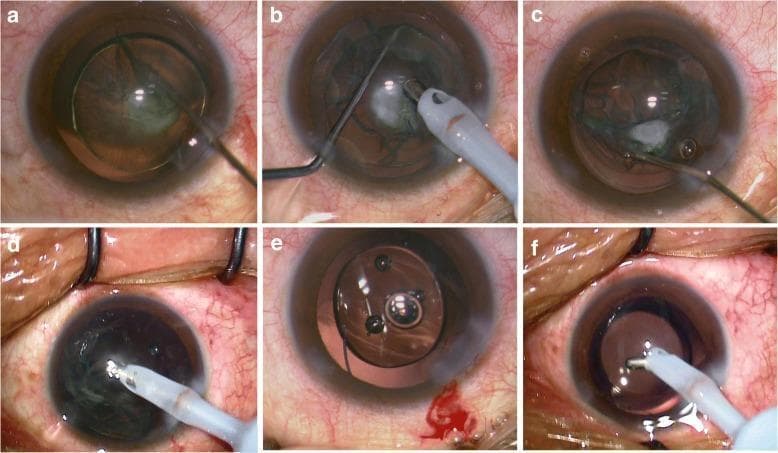 A series of six clinical photographs (a-f) documenting intraoperative stages of cataract surgery and intraocular lens (IOL) implantation. (a) Displays a 'golden ring' reflex indicating hydrodelineation, separating the lens nucleus from the epinucleus. (b) Demonstrates phacoemulsification using the phaco-chop technique to fragment the nucleus while maintaining the posterior capsular cataract (PPC) and epinucleus. (c) Shows OVD-assisted hydrodissection, where viscoelastic material is used to lift the PPC from the posterior capsule. (d) Illustrates the irrigation/aspiration phase for the removal of the remaining epinuclear and PPC material. (e) Details the surgical management of a posterior capsular rupture, showing a 3-piece acrylic IOL implanted into the ciliary sulcus for stable fixation. (f) Shows a standard 1-piece acrylic IOL successfully positioned within the intact capsular bag. This educational sequence highlights diagnostic landmarks, surgical maneuvers for complex cataracts, and complication management in ophthalmology.