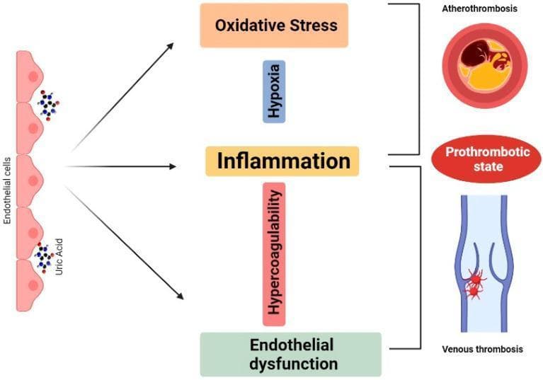 A pathophysiology diagram illustrating the proposed mechanism linking uric acid to thrombosis. The flowchart progresses from left to right. On the far left, an illustration of the vascular endothelium shows uric acid molecules being absorbed by endothelial cells. This process triggers three central intermediary pathways: 'Oxidative Stress', 'Inflammation', and 'Endothelial dysfunction'. These pathways are further modulated by factors labeled 'Hypoxia' and 'Hypercoagulability'. On the right, the diagram culminates in three clinical outcomes: 'Atherothrombosis' (represented by a cross-section of an artery with an occlusive plaque), a 'Prothrombotic state', and 'Venous thrombosis' (depicted by a venous valve with a developing red thrombus). The visual layout uses arrows and brackets to establish a causal relationship between hyperuricemia-induced cellular stress and various forms of vascular clotting. This educational diagram is intended for medical students and clinicians studying cardiovascular pathophysiology and the metabolic drivers of thrombotic disease.