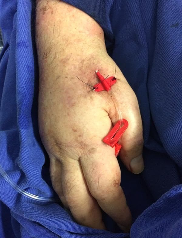 Clinical photograph of a 20-G arterial catheter inserted into the right radial artery via a distal puncture approach in the anatomical snuffbox (radial fossa). The image shows a clear catheter tube running along the dorsal aspect of the hand. The insertion site is stabilized by a red fixation device that is sutured to the skin with dark, non-absorbable thread. An additional red clip further secures the distal portion of the catheter near the thumb. The patient's hand displays fair, freckled skin with signs of aging, such as thinning and prominent dorsal veins. This image demonstrates the clinical application of the Seldinger technique for distal radial artery cannulation, a site used for invasive arterial blood pressure monitoring and blood gas sampling. The procedure is shown post-fixation, highlighting the specific anatomical landmarks of the dorsal hand used for this alternative arterial access point.