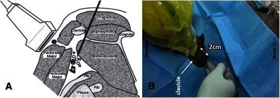 This dual-panel medical figure illustrates the anatomical and procedural approach for an ultrasound-guided posterior infraclavicular brachial plexus block. Panel A is a labeled anatomical diagram depicting a parasagittal section of the shoulder medial to the coracoid process. Key structures include the clavicle, scapula, and ribs, with muscular landmarks such as the trapezius, supraspinatus, subscapularis, deltoid, and pectoralis major. The brachial plexus nerves (N) are shown clustered around the axillary artery (A) and vein (V), superficial to the pleura. An ultrasound probe is positioned anteriorly on the chest wall, while a block needle follows a posterior-to-anterior trajectory, passing between the clavicle and scapula towards the neurovascular bundle. Panel B is a clinical photograph showing the surface anatomy and procedural setup. It indicates the ideal needle insertion point located 2 cm posterior to the clavicle, serving as a landmark to ensure the needle clears the inferior surface of the bone to reach the infraclavicular space. This content is designed for anesthesiology training, focusing on regional anesthesia techniques and ultrasound-guided nerve blocks.