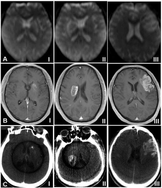 This diagnostic imaging composite illustrates the radiological classification of hemorrhagic transformation (HT) in the brain across three modalities: (A) Arterial Spin Labeling (ASL) MRI, (B) Dynamic Contrast-Enhanced (DCE) MRI, and (C) Xper CT. The images are categorized into three types based on the morphology and volume of the lesion relative to the cerebral infarction focus. Type I demonstrates focal HT, characterized by high signal (MRI) or high density (CT) distributed in small dots or stripes along the periphery of the infarct. Type II shows confluent patches of high signal/density within the infarct area, involving less than 30% of the total infarction volume. Type III represents the most severe form, where high-intensity signals or high-density contrast extravasation appear as dense sheets occupying 30% or more of the infarction focus. These findings are critical for post-endovascular treatment monitoring, where high signals on ASL and DCE indicate increased regional cerebral blood flow and blood-brain barrier permeability, respectively. The images provide a standardized visual reference for neuroradiology and neurology education regarding post-ischemic stroke complications.