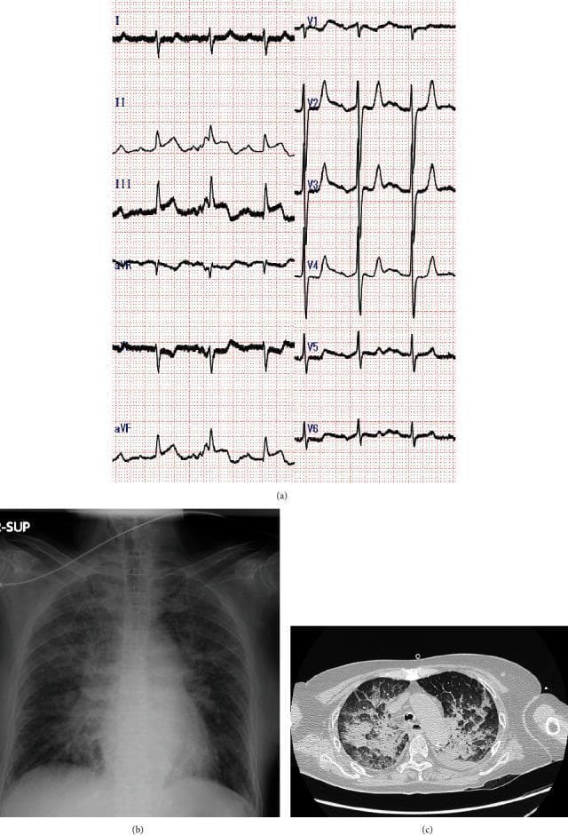 A multi-panel clinical diagnostic set showing a 12-lead electrocardiogram (ECG), a chest radiograph, and a CT scan of the chest. (a) The 12-lead ECG demonstrates sinus tachycardia with marked ST-segment elevation in the inferior leads (II, III, and aVF), consistent with acute inferior myocardial infarction. (b) The anteroposterior chest radiograph shows bilateral, symmetric perihilar opacities in a 'butterfly' or 'bat-wing' distribution, characteristic of acute pulmonary edema and alveolar congestion. (c) The axial chest CT scan (lung window) reveals diffuse, bilateral ground-glass opacities and areas of consolidation, particularly in the dependent and perihilar regions, further supporting the diagnosis of severe pulmonary edema or acute respiratory distress syndrome. These visuals together illustrate a clinical scenario of acute coronary syndrome complicated by acute heart failure and cardiogenic pulmonary edema.