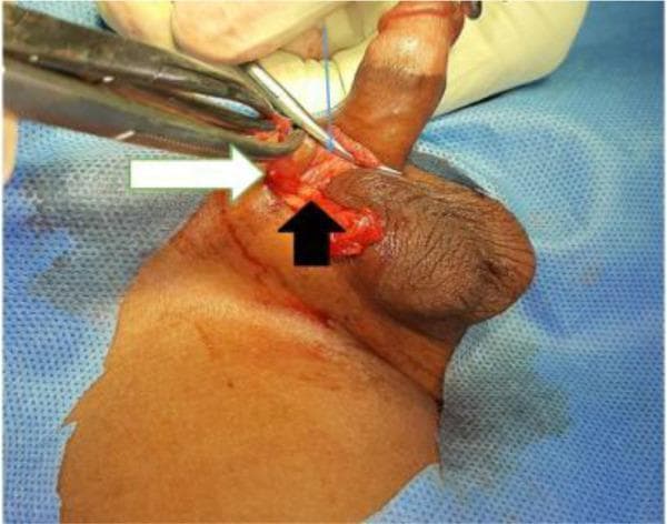 This clinical photograph captures an intraoperative view of a pediatric inguinal hernia repair performed via a high scrotal approach. The surgical field displays the dissected inguinal-scrotal region with key anatomical structures identified by colored arrows. A thick white arrow points to the translucent, reddish hernia sac being held and retracted by surgical forceps. A thin blue arrow indicates the spermatic fascia, which has been opened to expose the internal structures. A short black arrow highlights the cord structures, encompassing the vas deferens and testicular vessels, which are being carefully separated from the hernia sac. The image illustrates the critical surgical step of isolating the sac from the spermatic cord to ensure high ligation while preserving vital reproductive and vascular components. This visual is used to demonstrate surgical anatomy during inguinal herniotomy and to contrast the scrotal incision technique with the traditional groin crease approach.