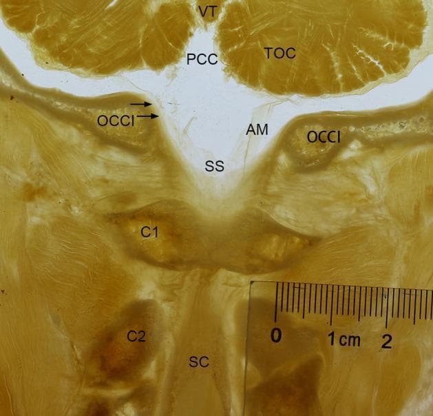 A frontal P45 plastinated anatomical section of the human occipito-cervical junction (OCJ) passing through the posterior arch of the atlas (C1). The specimen demonstrates the morphological relationship between the cerebellum and the upper cervical spine. Key structures labeled include the tuber of vermis (VT) and tonsil of cerebellum (TOC) superiorly. The posterior cerebellomedullary cistern (PCC) is visible above the foramen magnum. A prominent, rhombic-shaped subarachnoid space (SS) is observed between the cerebellum and the atlas (C1), bordered by the arachnoid membrane (AM) and the spinal dura mater (indicated by arrows). Bony landmarks identified include the occipital bone (OCCI), the atlas (C1), and the axis (C2). The spinal cord (SC) is visible descending through the vertebral canal. The image illustrates the continuity of the subarachnoid space from the posterior cranial fossa into the upper cervical vertebral canal, highlighting the anatomy of the cisterna magna and the dural sac at the craniocervical transition. A metric ruler is included for scale.