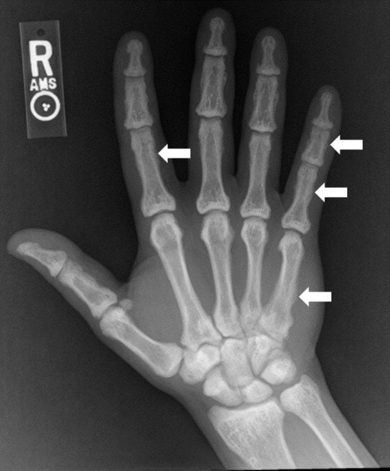 This anteroposterior (AP) radiograph of the right hand and wrist demonstrates diffuse skeletal sclerosis, characterized by a generalized increase in bone density across the metacarpals, phalanges, and carpal bones. The osseous structures appear hyper-opaque with a significant loss of normal corticomedullary differentiation; the medullary cavities are nearly obliterated by dense trabecular bone. Several white arrows highlight focal abnormalities along the diaphyses, including the second proximal phalanx, the fifth metacarpal, and the fifth proximal and intermediate phalanges. These areas exhibit irregular, indistinct cortical margins and subtle periosteal reactions, giving the bone surfaces a smudged appearance. Such widespread osteosclerosis in the small bones of the hand is a key radiological finding for systemic metabolic or toxic bone conditions, such as skeletal fluorosis. The image serves as a clinical example of secondary osteosclerosis and its impact on peripheral skeletal architecture.