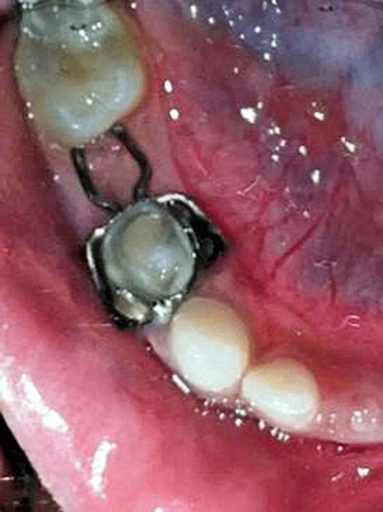 An intraoral clinical photograph showing a distal shoe space maintainer in a pediatric patient. A stainless steel band is securely fitted around the primary first molar. Attached to this band is a wire framework consisting of buccal and lingual arms with horizontal adjustment loops. The wire extends distally across the extraction site of the primary second molar to guide the eruption of the permanent mandibular first molar. The mesial aspect of the partially erupted permanent first molar is visible, making contact with the distal extension of the appliance. The surrounding gingival tissues show mild erythema and inflammation around the band margin and the site of the intra-alveolar projection. This image demonstrates the clinical application of a fixed passive space maintainer used in pediatric dentistry to prevent the mesial tipping of permanent molars following the premature loss of primary second molars.