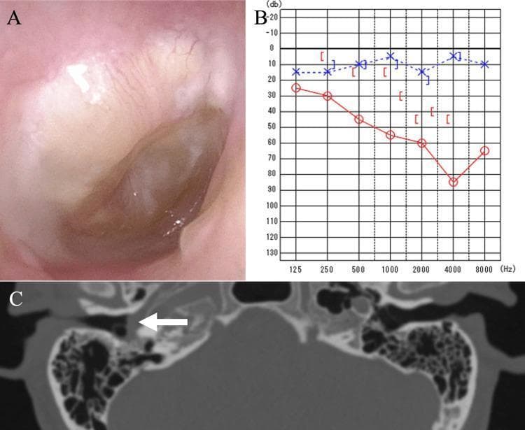 This composite diagnostic image illustrates a clinical case of right-sided otitis media through three modalities. Panel A is an otoscopic photograph of the right ear showing a bulging, erythematous tympanic membrane with visible opacification and fluid accumulation in the tympanic cavity. Panel B displays a pure-tone audiogram showing a significant air-bone gap and a downward-sloping red line, indicating a mixed hearing loss of approximately 55 dB in the right ear. Panel C is an axial computed tomography (CT) scan of the temporal bones; a white arrow indicates complete soft-tissue opacification of the right tympanic cavity. Notably, the CT shows no evidence of bony erosion or ossicular destruction, distinguishing this from more aggressive middle ear pathologies. Together, these images demonstrate the typical diagnostic workup for chronic or fungal-associated otitis media, emphasizing the correlation between clinical appearance, functional hearing deficit, and radiological findings.