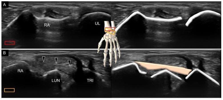 This medical figure presents high-resolution musculoskeletal ultrasound (US) imaging and corresponding schematic overlays of the dorsal wrist anatomy. Panel A demonstrates the distal radioulnar joint (DRUJ) in a short-axis transverse view. The radius (RA) and ulna (UL) appear as hyperechoic bony cortices with characteristic posterior acoustic shadowing. Panel B illustrates the dorsal radiocarpal ligament (indicated by black arrowheads) in a longitudinal scanning plane. The ligament is visualized as a moderately echogenic, fibrillar structure bridging the distal radius (RA), lunate (LUN), and triquetrum (TRI). The schematic drawings on the right side of each panel highlight the bony contours and ligamentous path for educational clarity. A central 3D anatomical model of the hand indicates the relative transducer positions (red and orange boxes) for each view. This visual resource is designed for ultrasound training in identifying extrinsic carpal ligaments and evaluating wrist stability, emphasizing the spatial relationships between the distal forearm bones and the proximal carpal row.