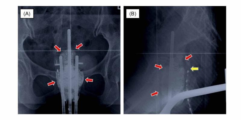 This diagnostic imaging set consists of two orthogonal pelvic radiographs, anterior-posterior (A) and lateral (B), demonstrating the setup for two-dimensional intracavitary brachytherapy (2D-ICBT) for cervical cancer. The images show radiopaque intracavitary applicators (tandem and ovoids) centrally positioned within the pelvic cavity. Red arrows in both views indicate the placement of vaginal packing, which is used to increase the distance between the radiation source in the uterus and the adjacent organs at risk (OAR), specifically the bladder anteriorly and the rectum posteriorly. In the lateral view (B), a yellow arrow identifies a rectal dosimeter, a radio-opaque marker string used to monitor real-time radiation exposure to the rectal mucosa. The radiographs serve as a clinical tool for 2D treatment planning, allowing for the verification of applicator geometry relative to pelvic bony landmarks and the positioning of protective packing to minimize the risk of late radiation-induced complications such as vesicovaginal or rectovaginal fistulas.